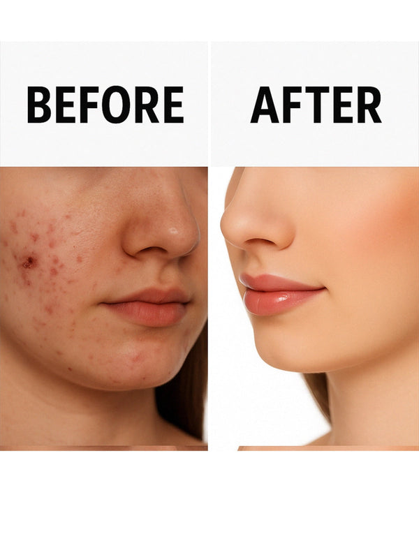 Essentials Acne Shield Gel