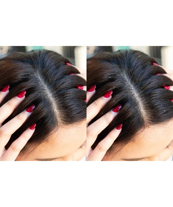 PureScalp Anti Dandruff Shampoo