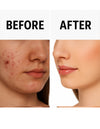 Essentials Acne Shield Gel